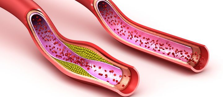 Cholesterin in einer Blutbahn